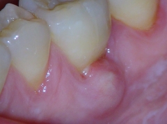 Leasies van Endodontische Origiene