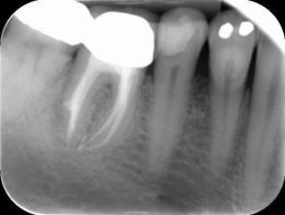  endodontische behandelingen